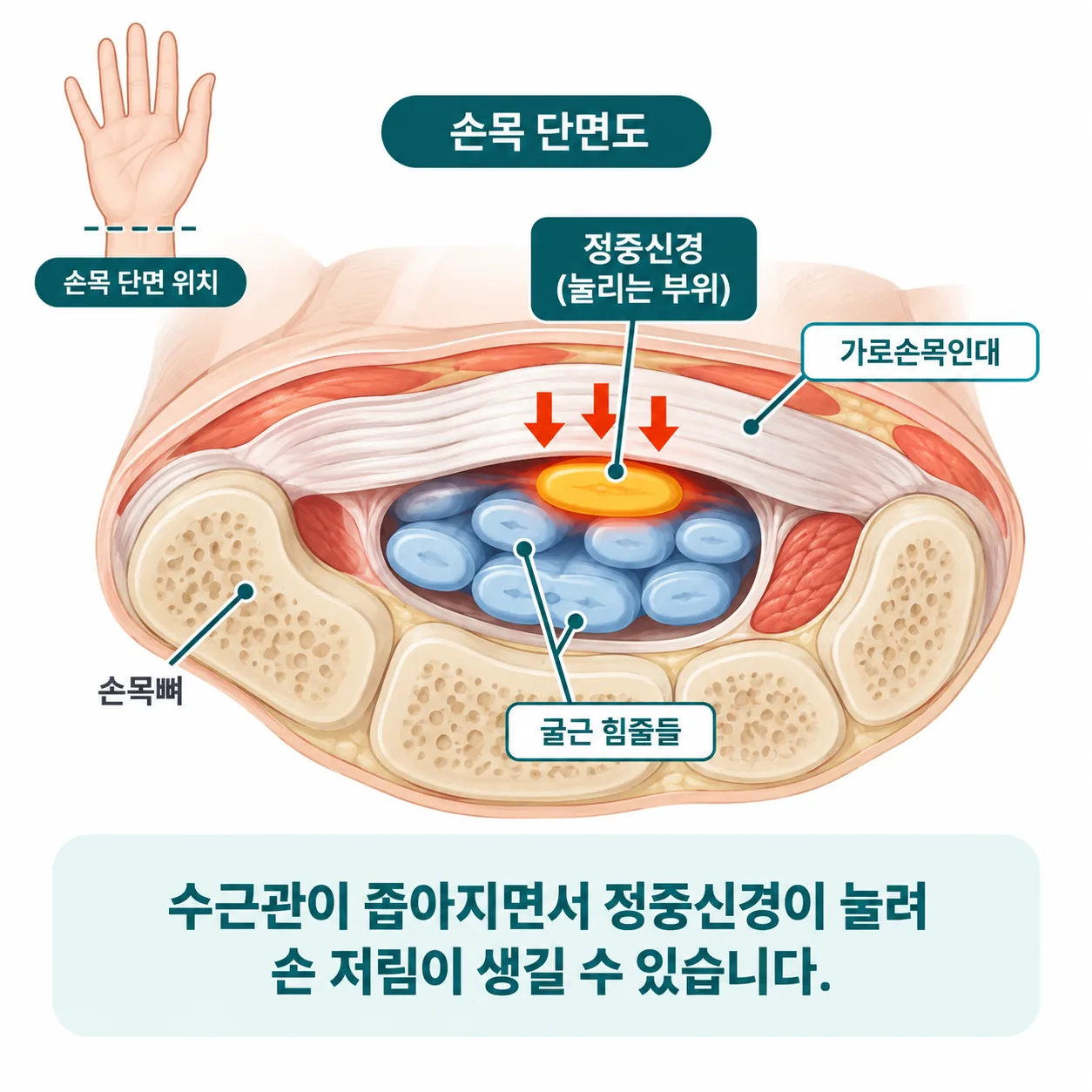 손목 수근관 단면에서 정중신경이 눌리는 위치를 표시한 개념도