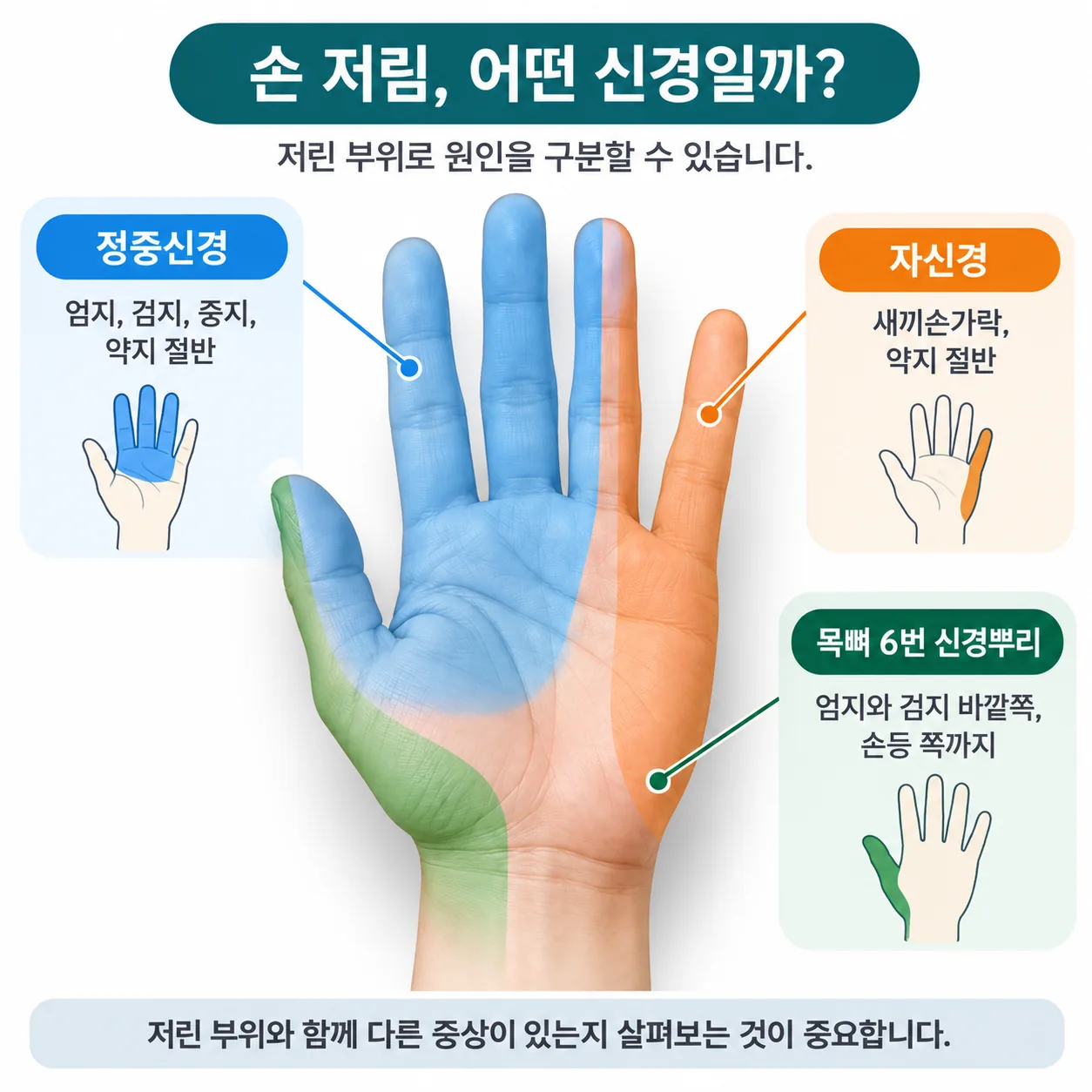 손바닥 그림에 세 신경이 담당하는 손가락 영역을 색으로 구분한 감별 도표