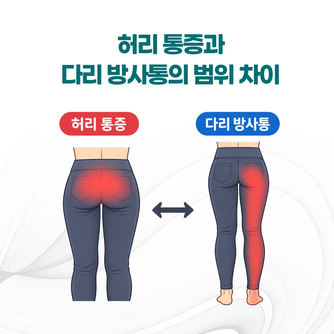 허리 통증과 다리 방사통의 범위 차이를 구분한 개념도