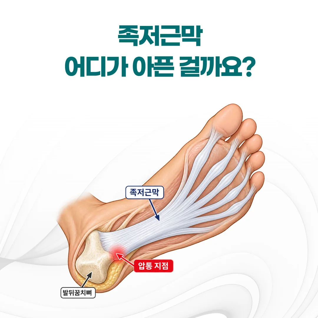족저근막이 발뒤꿈치뼈 안쪽에서 시작해 발가락 쪽으로 이어지는 구조와 압통 지점 도해