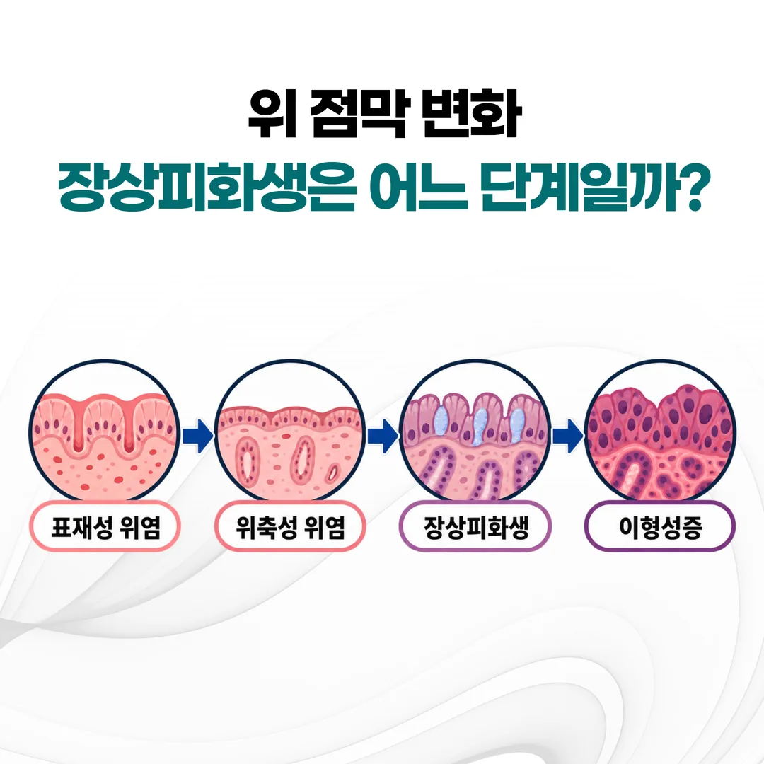 위점막이 표재성 위염에서 위축성 위염과 장상피화생을 거쳐 단계적으로 변해 가는 과정을 표시한 개념도