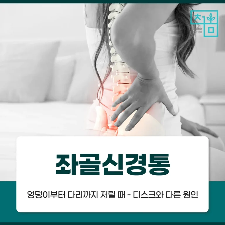 좌골신경통, 엉덩이부터 다리까지 저릴 때 — 디스크와 다른 원인