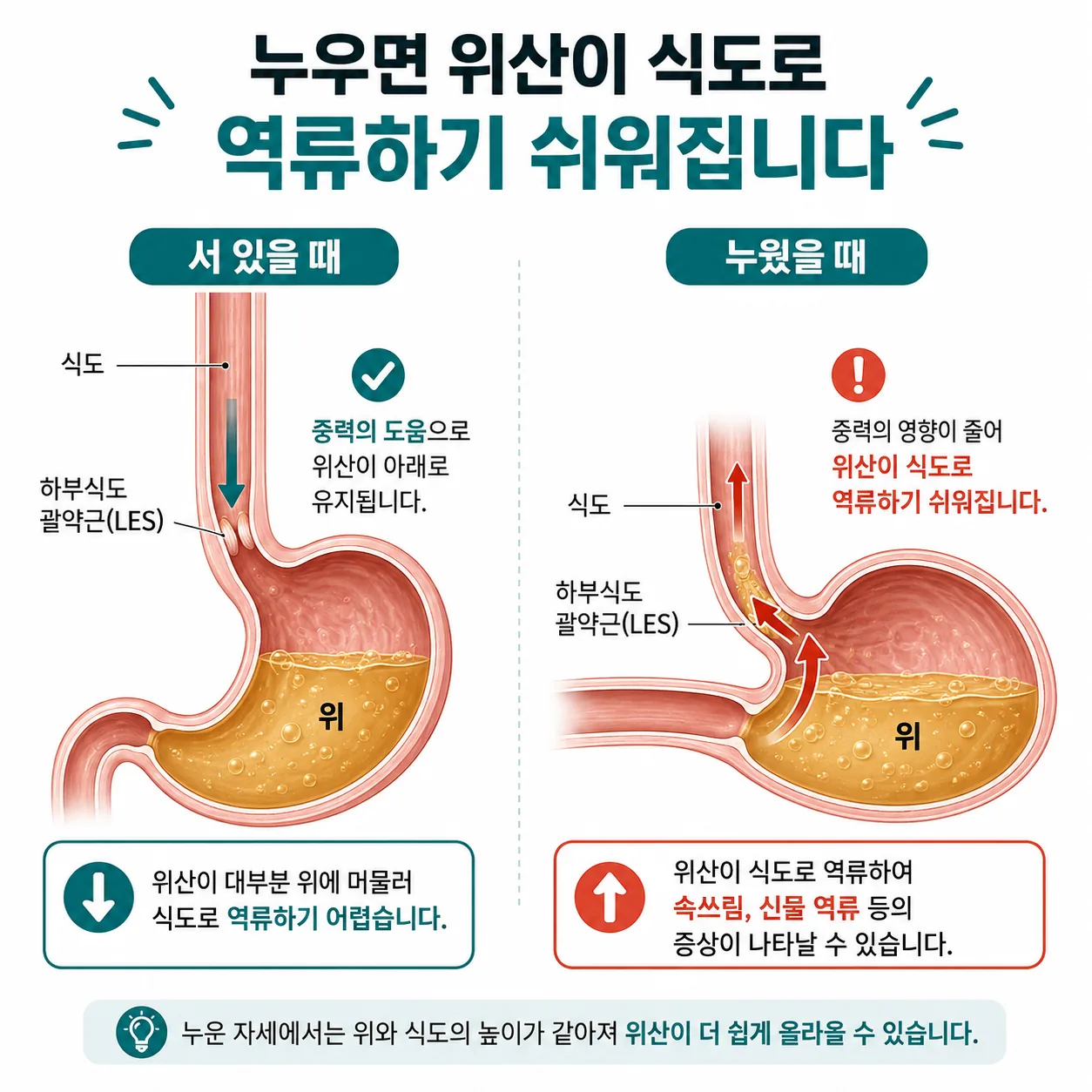 누우면 위산이 식도로 역류하기 쉬워지는 이유를 보여 주는 단면 도해