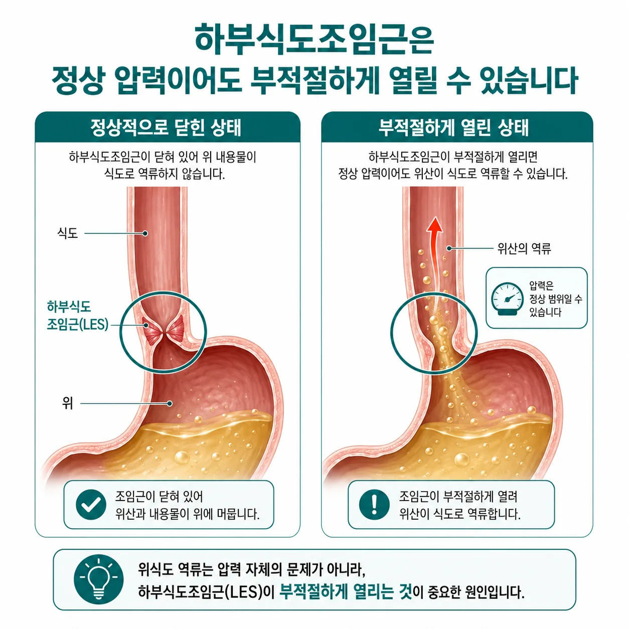 하부식도조임근이 정상 압력에서도 부적절하게 열리며 역류가 생기는 과정 도해