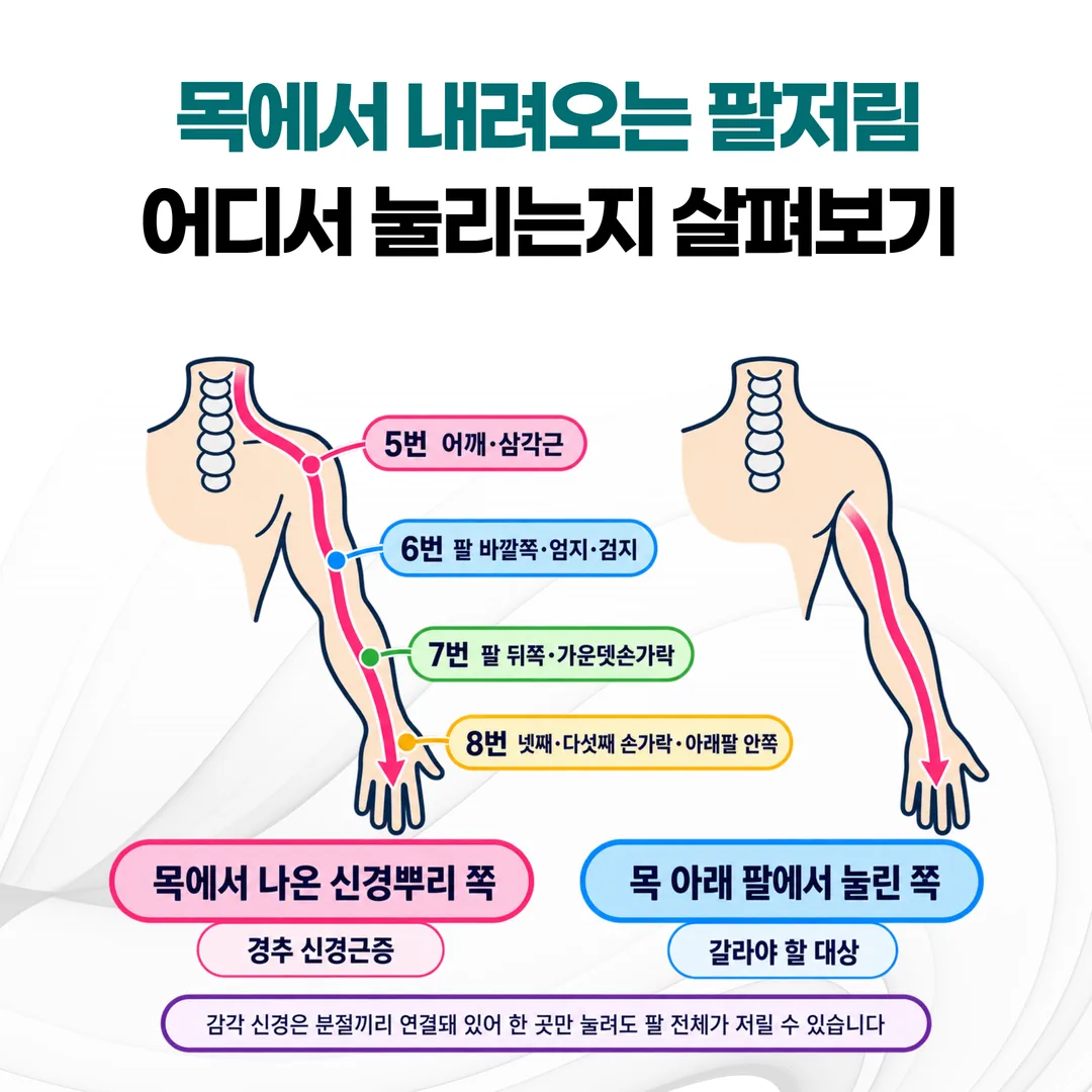 저림이 목에서 손가락까지 줄처럼 내려가는 경로와 손 안에만 머무는 경로를 좌우로 비교하고 마디별 담당 부위를 표시한 개념도